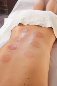 Photos show two different patients receiving cupping therapy — during and right after the treatment. The technique involves using a cup to create a vacuum on the skin to pull it upwards, away from the body, and suspend it. It’s safe and offers no pain, say practitioners.