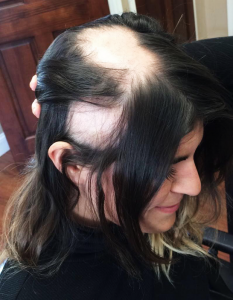 Photos of a patient from A Natural Image Hair Studio in Buffalo. The business is one of several in Western New York that provides hair loss solutions. Photo courtesy of A Natural Image Hair Studio.