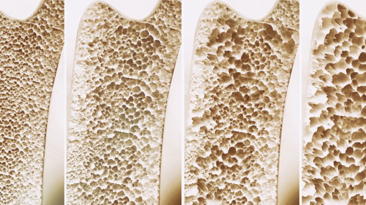 A 3-D rendering showing the progression of osteoporosis.